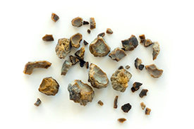 Kidney Stone Treatment in Los Angeles, CA